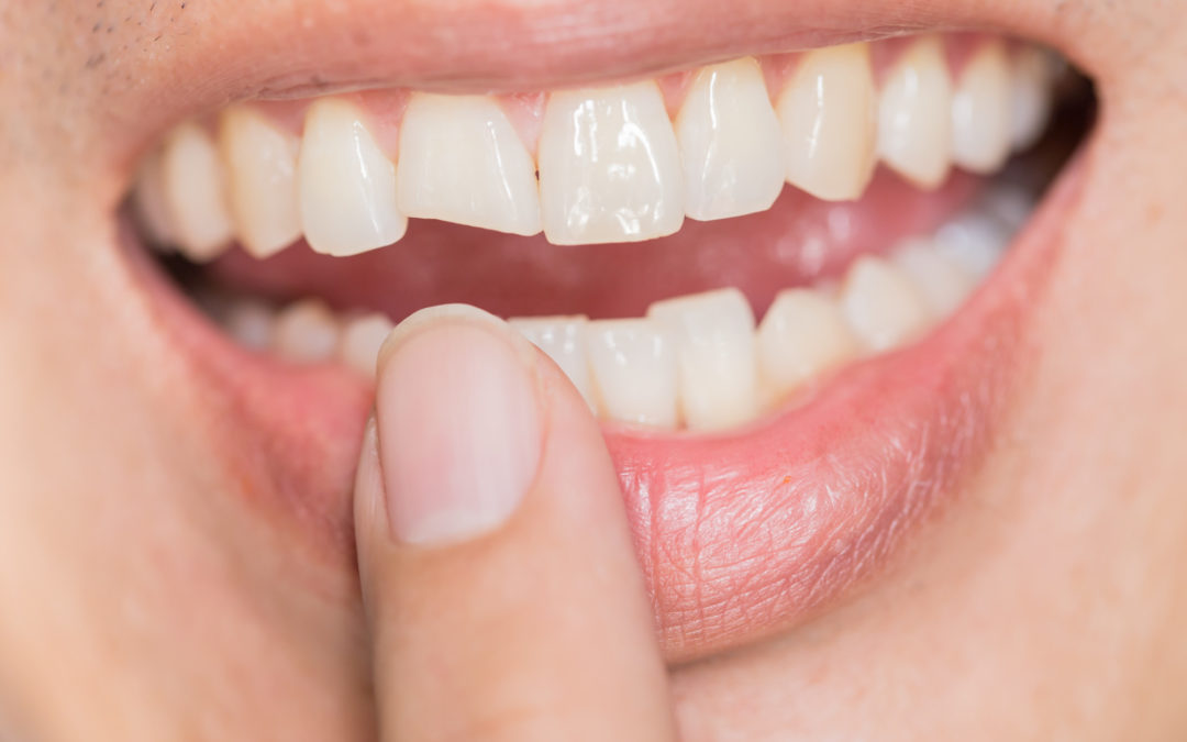 A Guide to Same Day Dental Implants